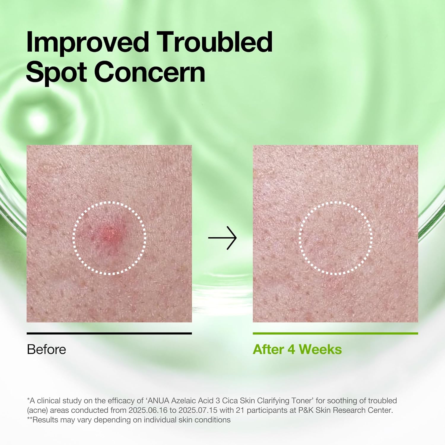 Anua Azelaic Acid 3 CICA Skin Clarifying Toner, Soothing & Clear Care, with Salicylic & Azelaic Acid, Sebum & Spot Care, Suitable for Sensitive Skin, Korean Skincare, 8.45 fl.oz - Image 6