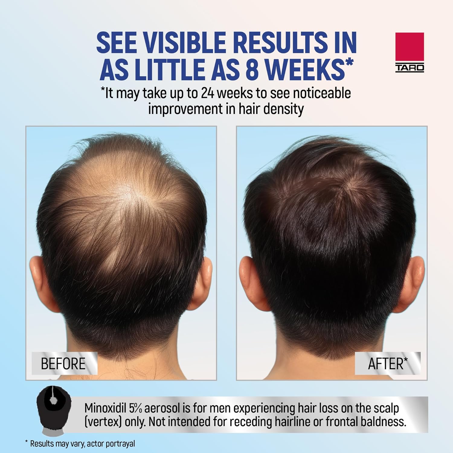 Minoxidil for Men, 2.11 Oz (1 Month Supply) Clinically Proven to Regrow Hair, Topical Aerosol Foam 5%, Hair Thinning Treatment - Image 4