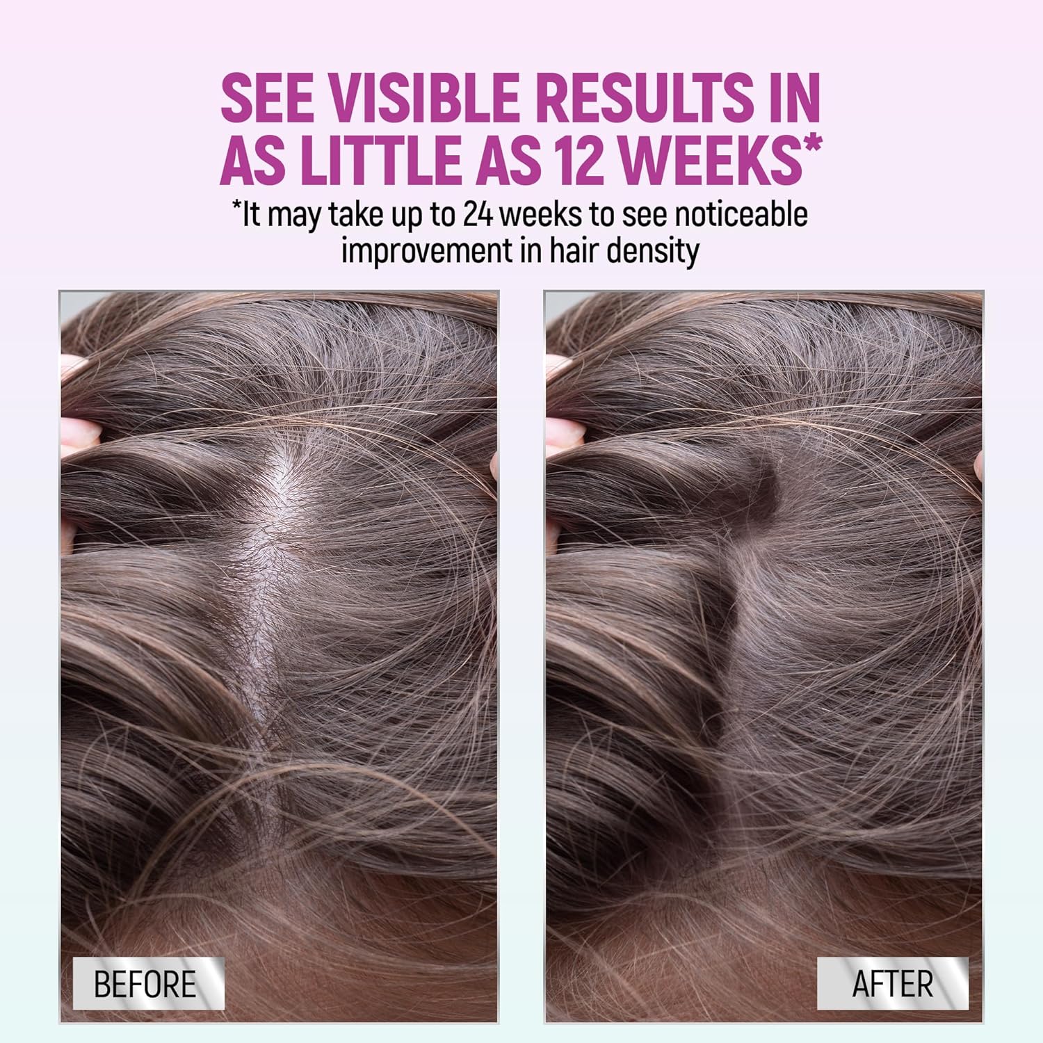 Minoxidil for Women, 2.11 Oz (2 Months Supply) Clinically Proven to Regrow Hair, Topical Aerosol Foam 5%, Hair Thinning Treatment - Image 7